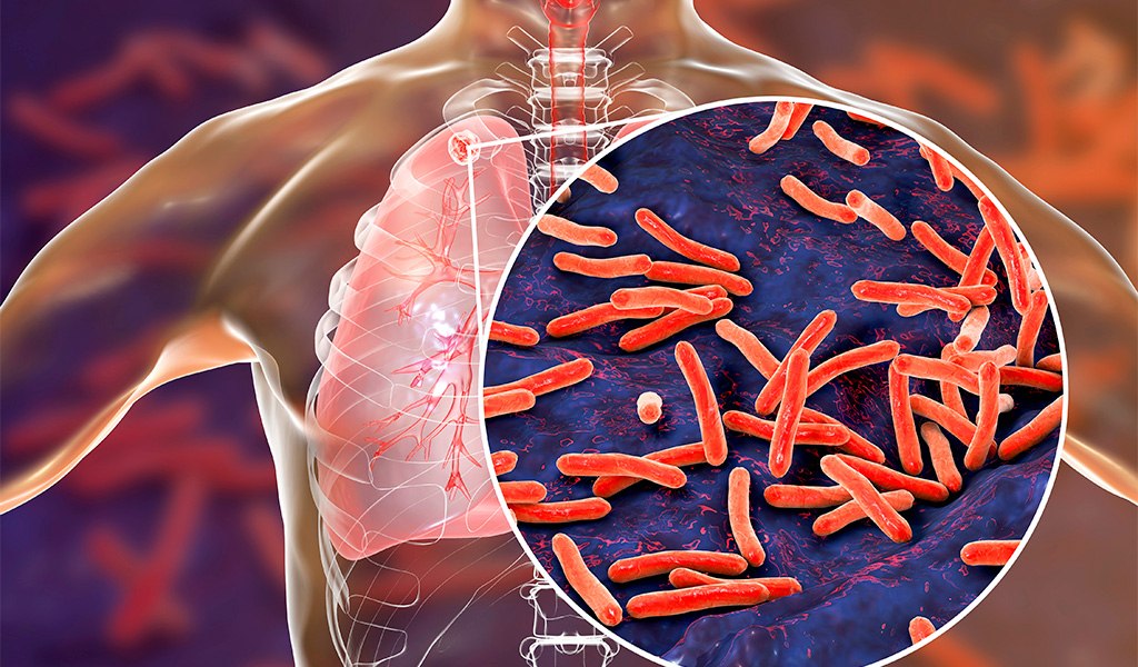 Hablemos de tuberculosis - Blog Laboratorio Proquimed